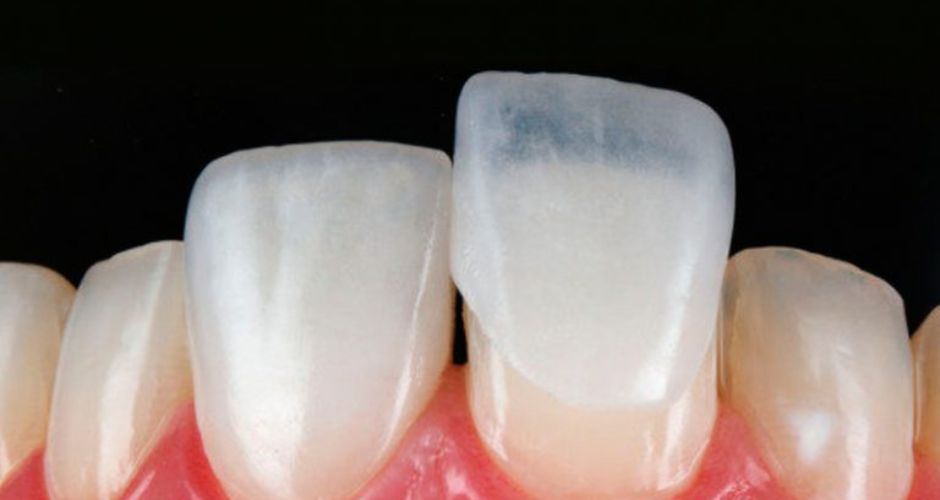 Lumineers - Alternative for Veneer Teeth