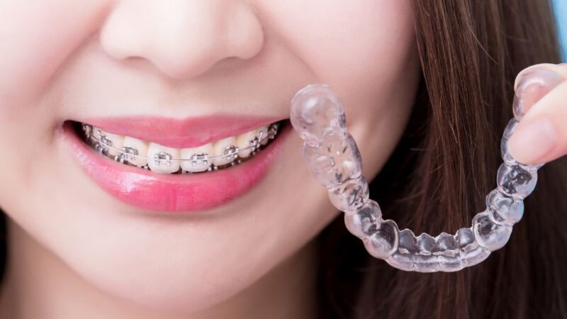 Braces vs. Invisalign: Which is the Right Choice