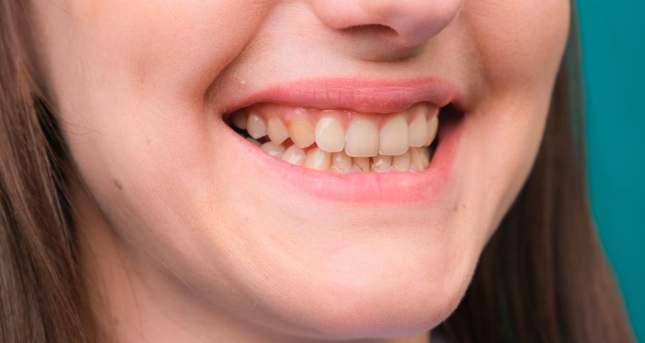 What Causes Yellow Stains on Teeth?